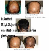 Before After Pictures,Photos,Delhi,Hair Transplantation
